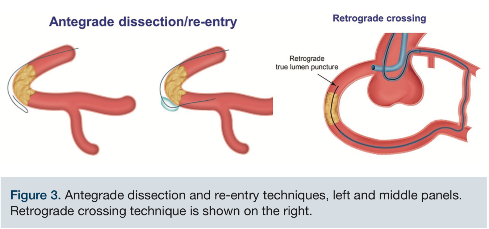 A Primer on Chronic Total Occlusion (CTO) Percutaneous Coronary